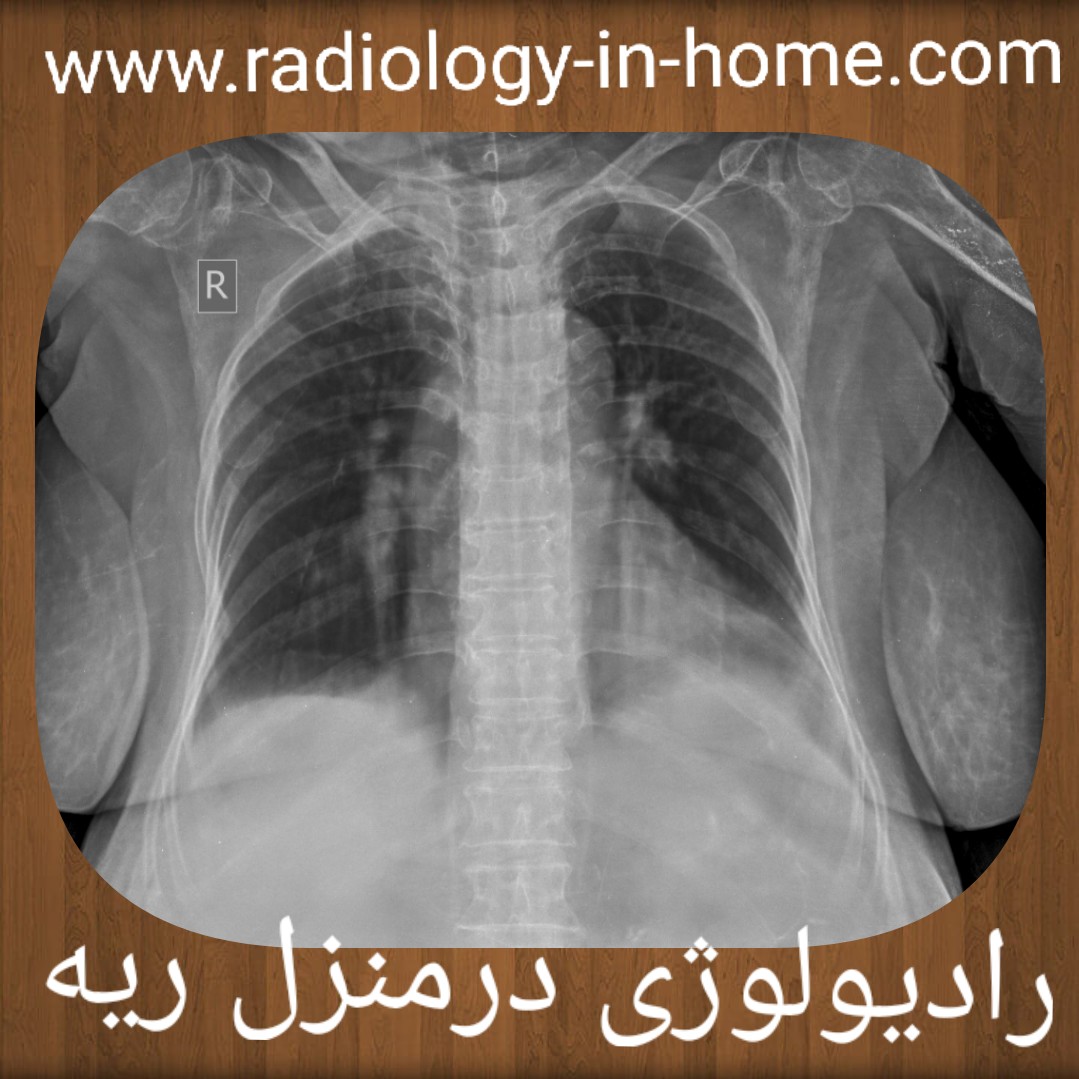 رادیولوژی در منزل ریه و قفسه سینه لگن بینی شکستگی لگن و ران پرتابل و سیار سونو در منزل تهران