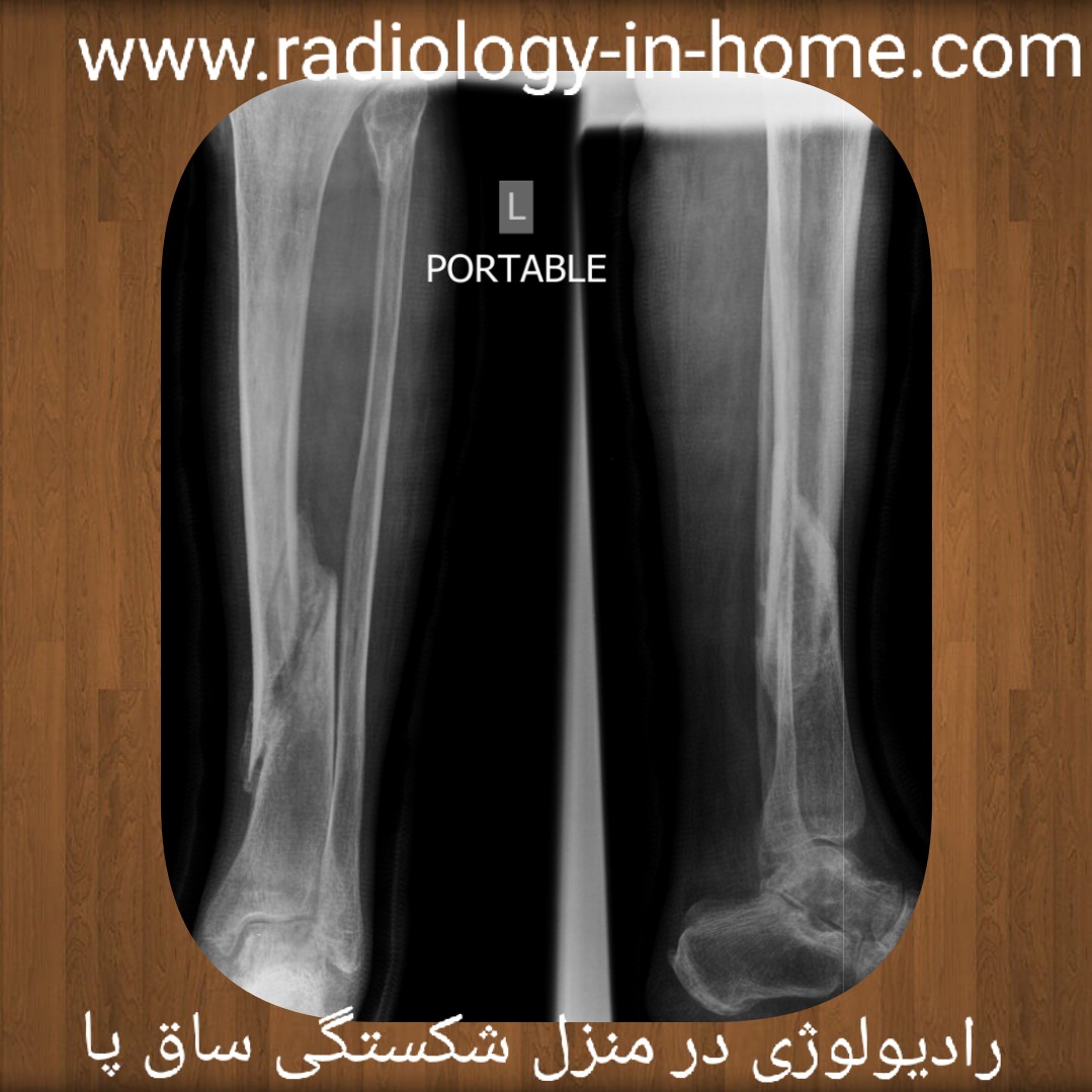 رادیولوژی ساق پا در منزل شیراز