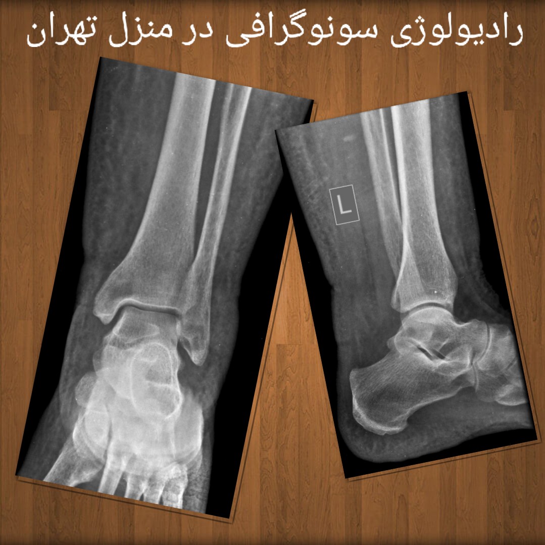 خدمات رادیولوژی در منزل و سونوگرافی کبد کلیه مثانه بارداری  حاملگی شکم کیسه صفرا پروستات بیضه در منزل در تهران Abdominal and pelvic ultrasound at home in Tehran  Kidney and bladder ultrasound at home in Tehran  Liver and gallbladder ultrasound at home in Tehran