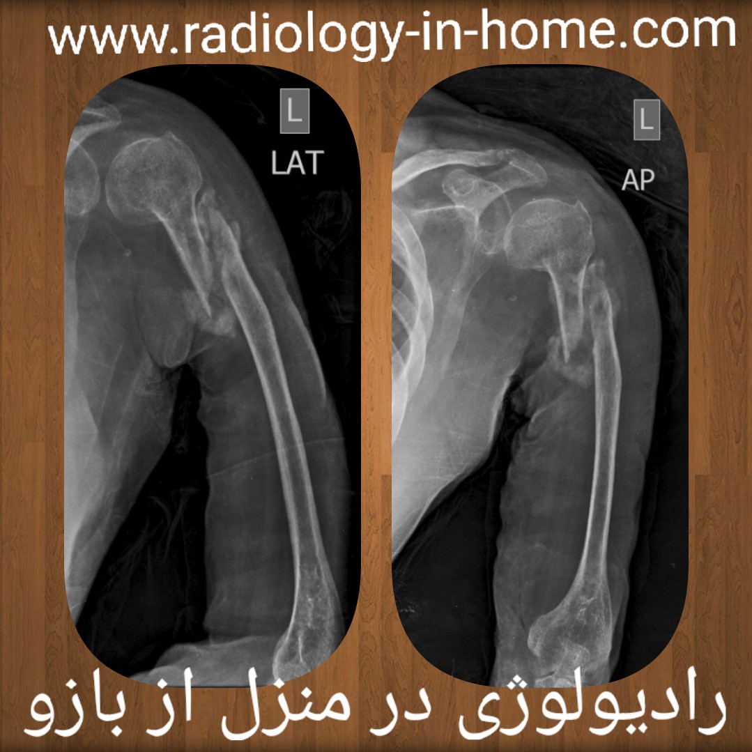 رادیولوژی در منزل شانه و بازو