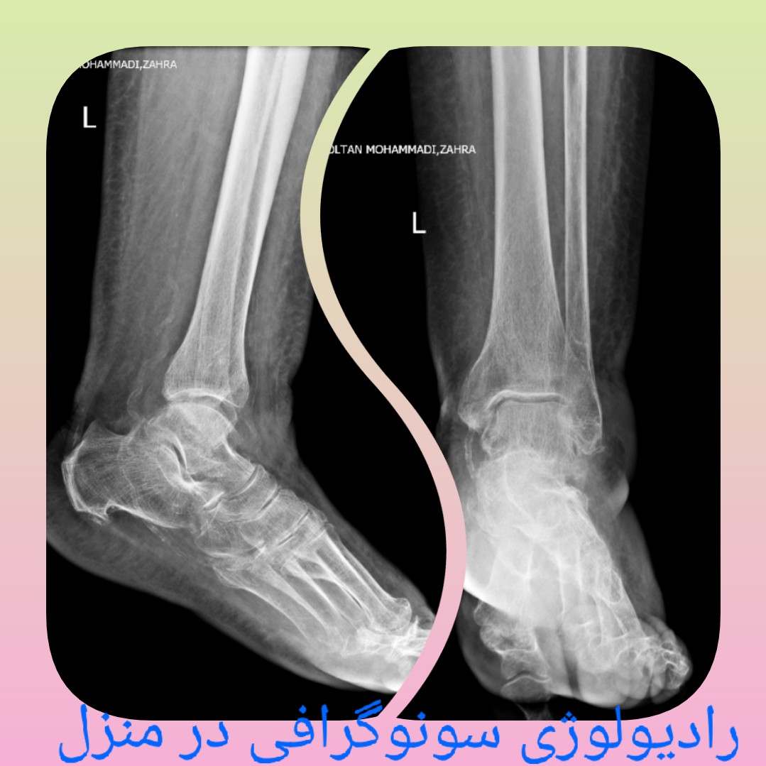 رادیولوژی در منزل تهران سونوگرافی در منزل تهران کرج  ادم و پلورال افیوژن ریه آپاندیس شکم کلیه مثانه کبد بارداری Radiology at home for pelvis, thigh, knee, lung, wrist, and foot in Tehran