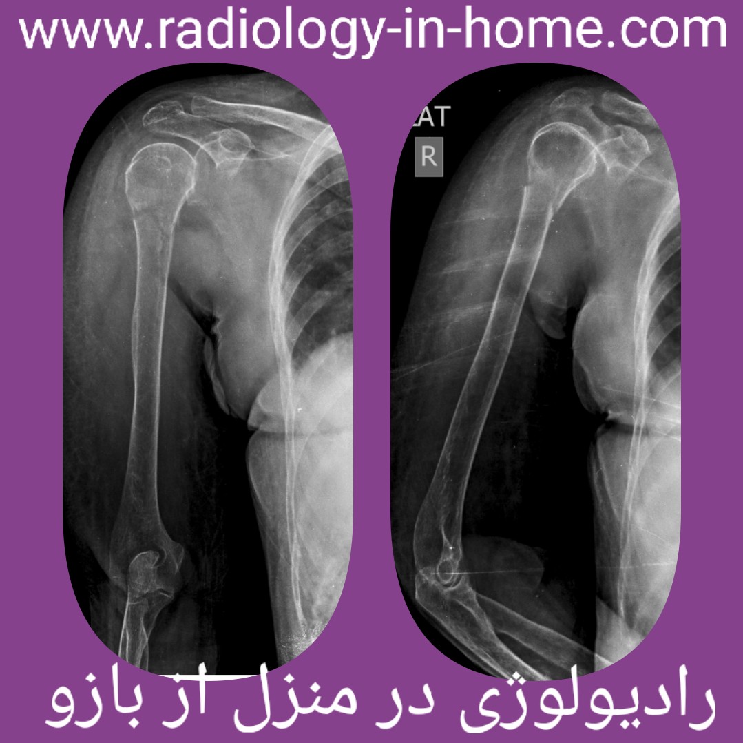 رادیولوژی در منزل شانه کتف و بازو