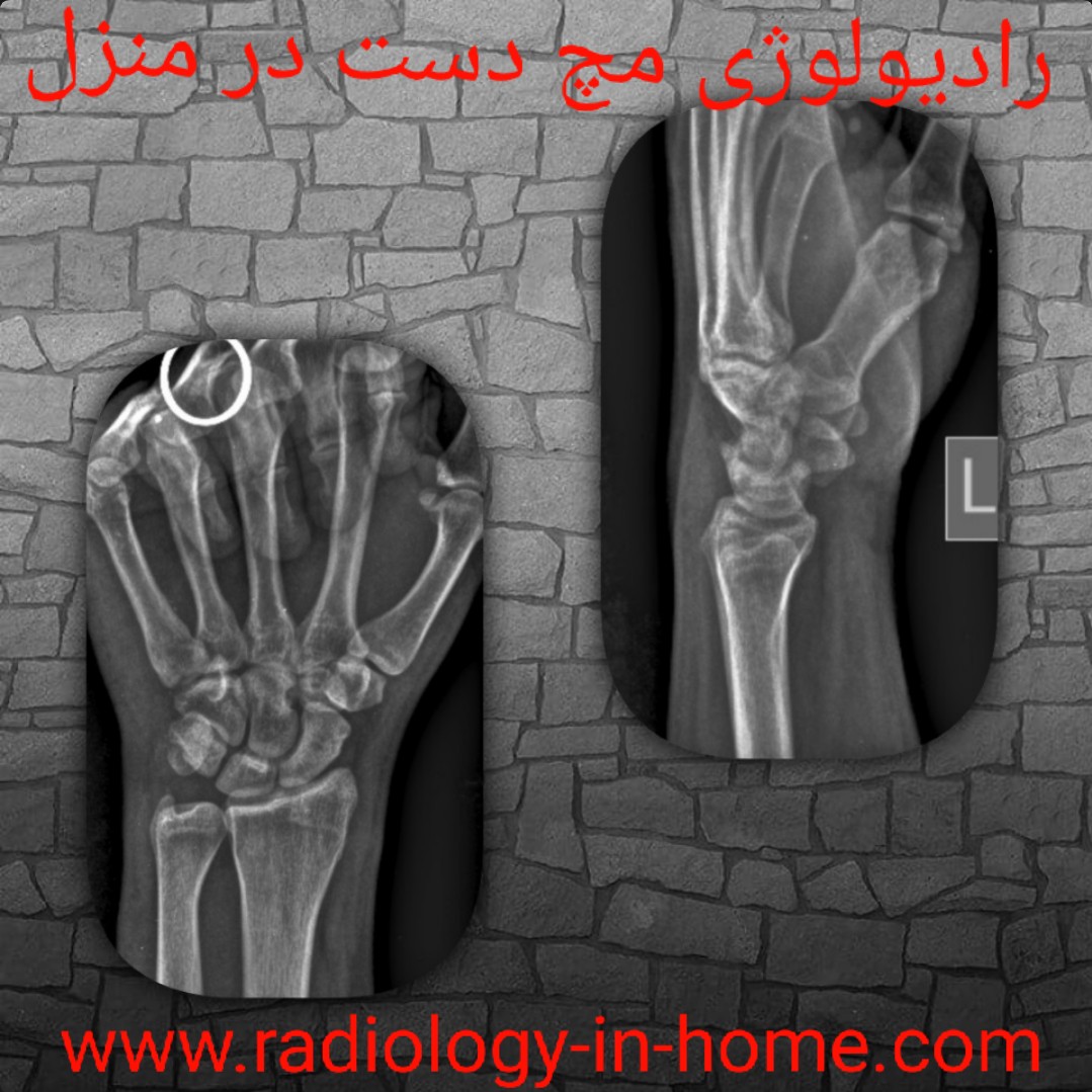 رادیولوژی در منزل مچ دست و پا و کف دست لگن و ران و ریه وقفسه سینه در مشهد