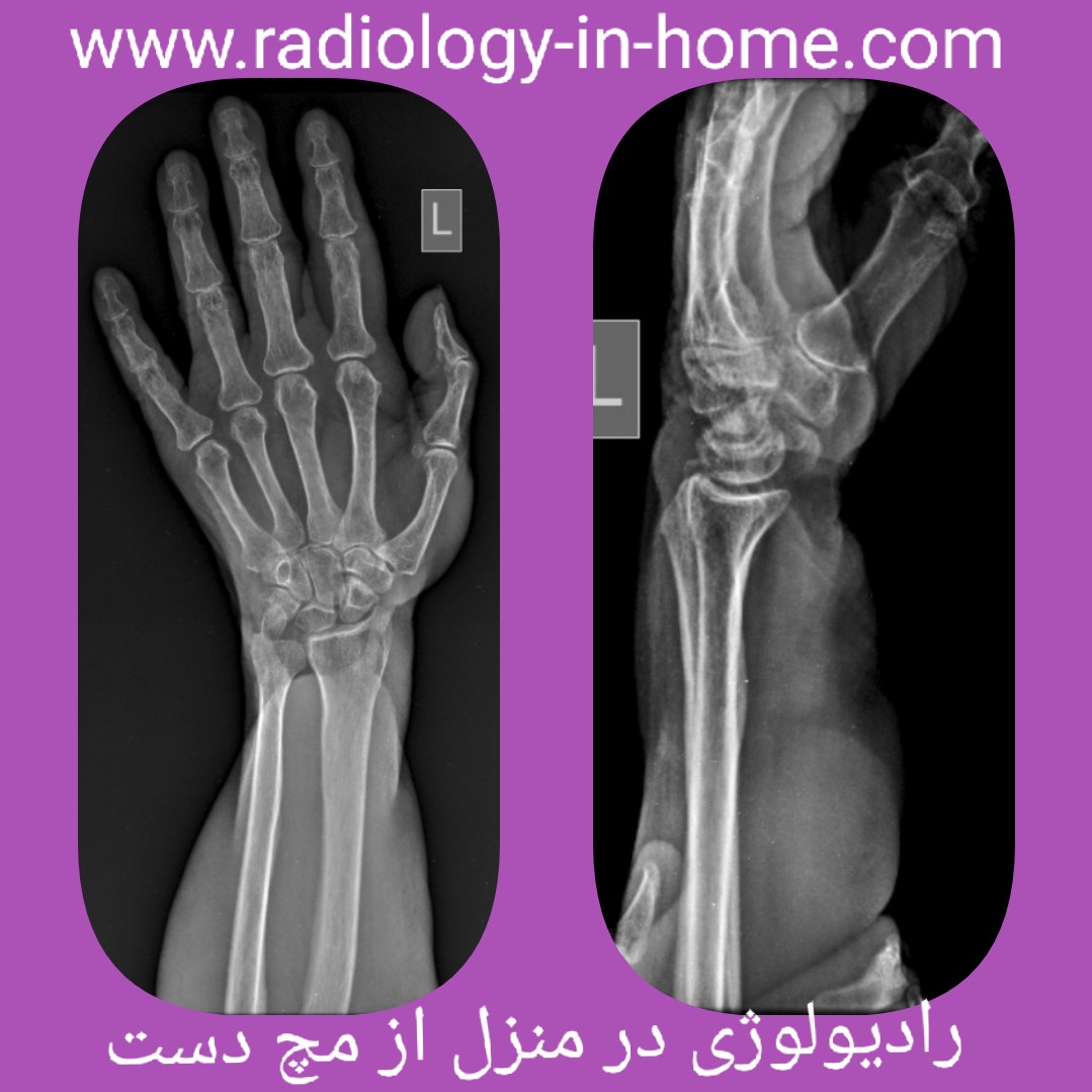 رادیولوژی در منزل مچ دست