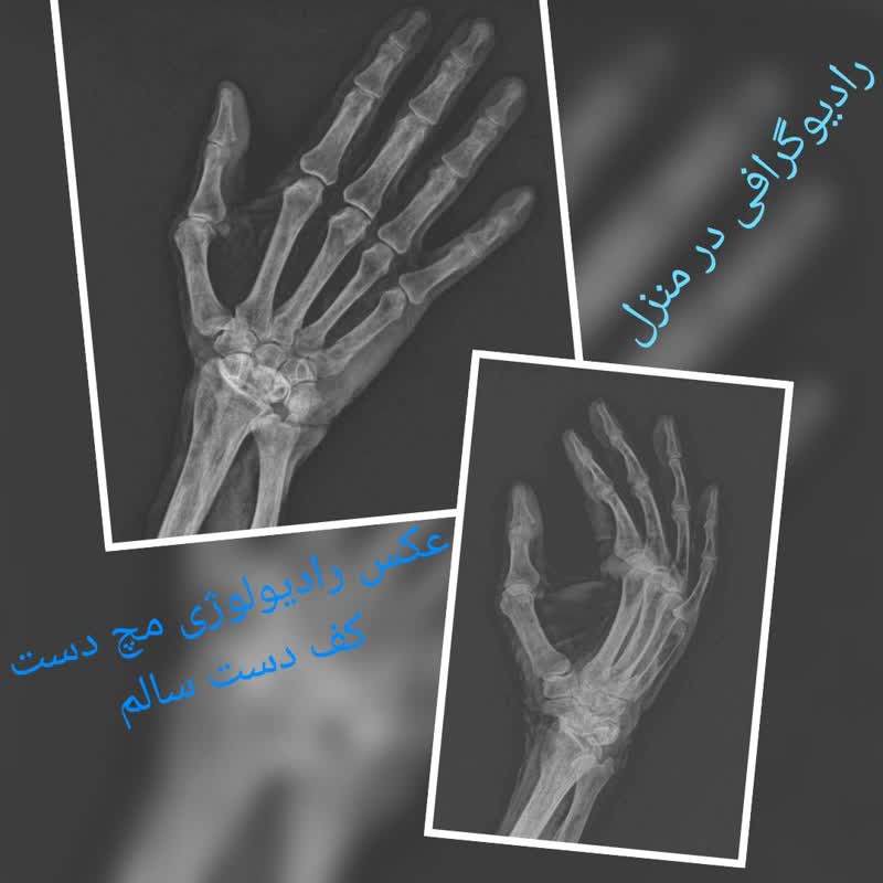 رادیولوژی در منزل مچ و کف دست سالم