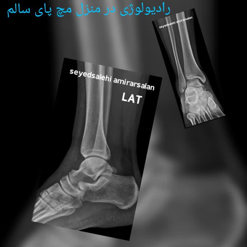 رادیولوژی در منزل مچ وپای سالم