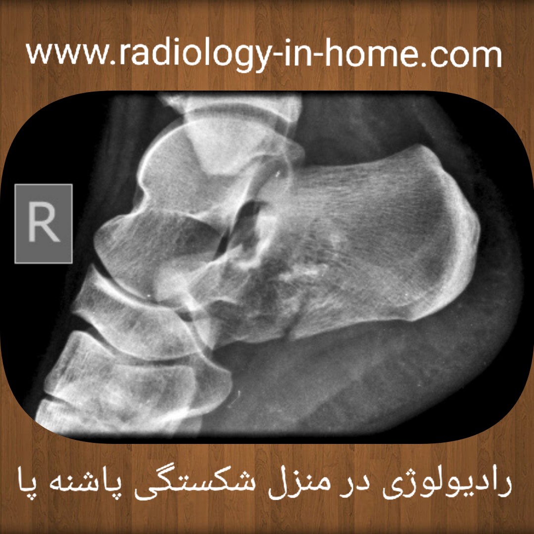 رادیولوژی در منزل مچ و پاشنه پا