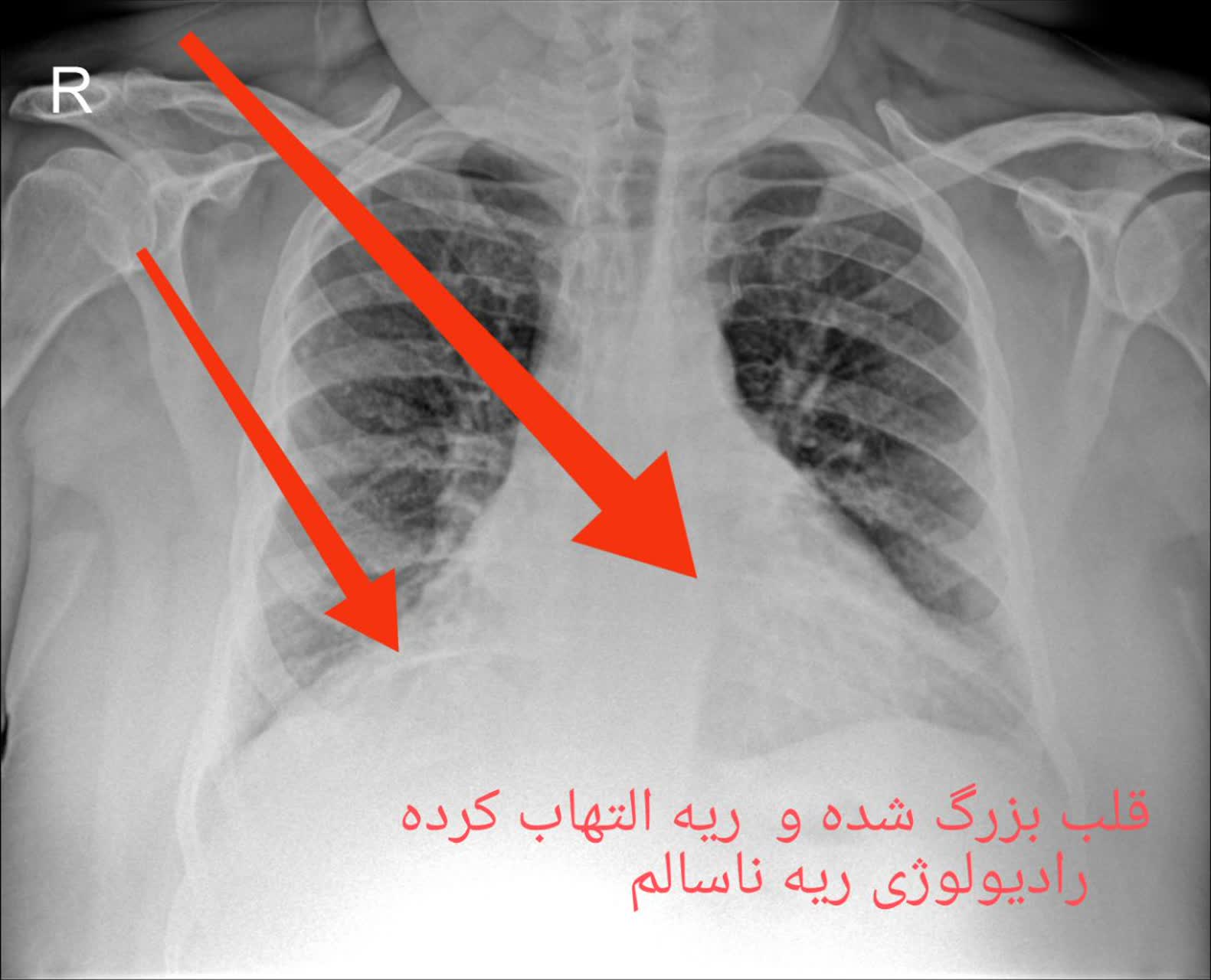 رادیولوژی ریه سالم و ناسالم در منزل تهران