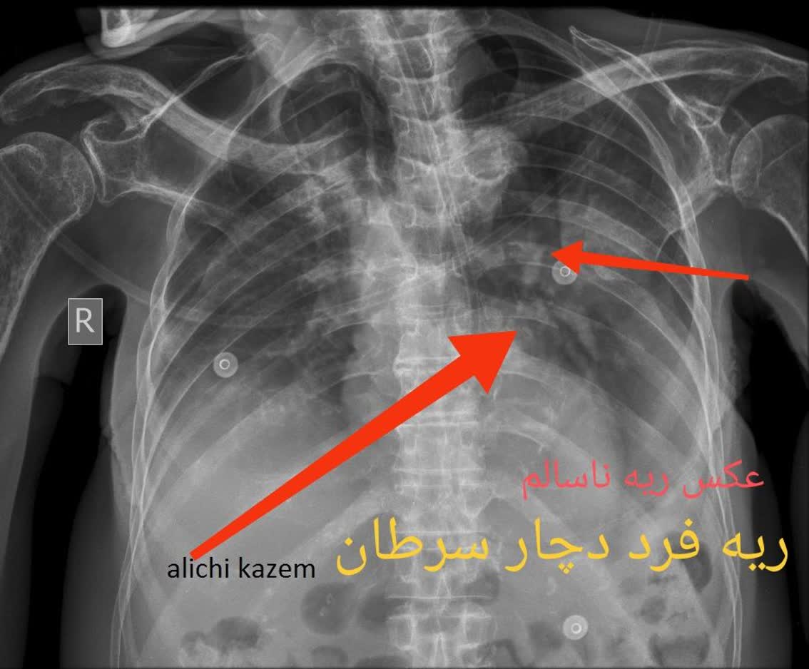 رادیولوژی ریه عکس سالم و ناسالم