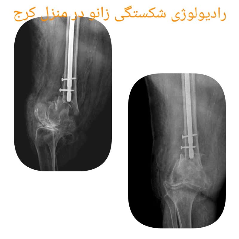 رادیولوژی زانو در منزل کرج