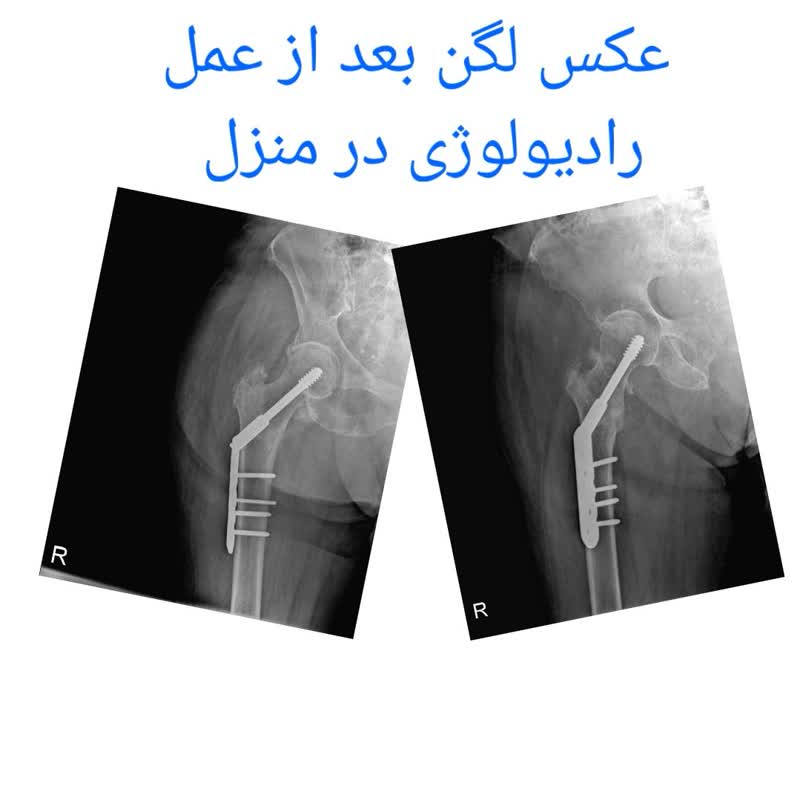 رادیولوژی لگن در منزل که دچار شکستگی شده است