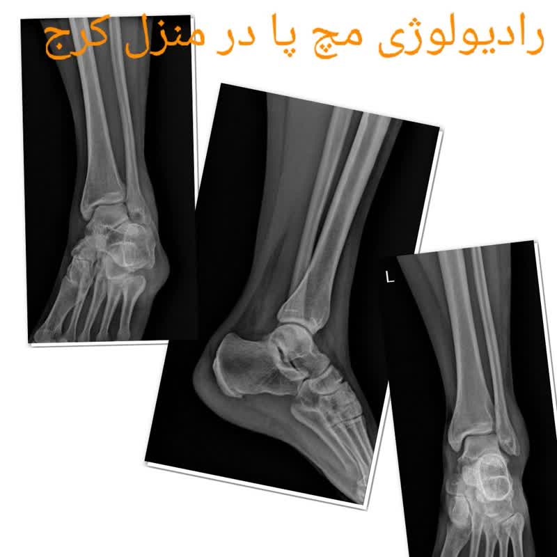 رادیولوژی مچ پا در منزل کرج
