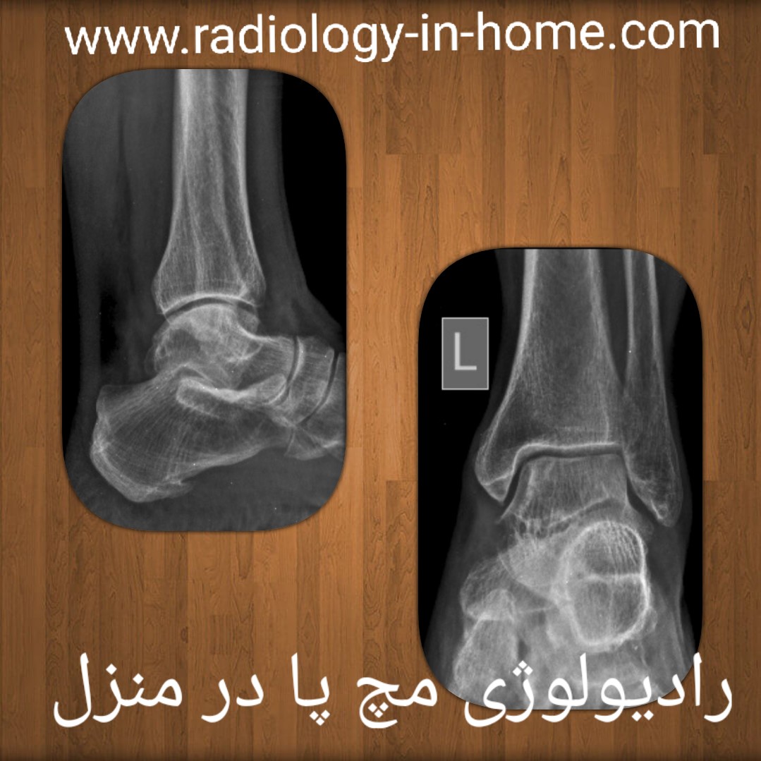رادیولوژی مچ دست وپا و کف دست وپا در منزل