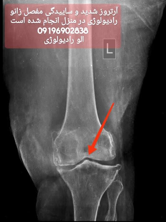 زانوی سالم و ناسالم-آرتروز زانو  ساییدگی زانو-رادیولوژی در منزل از زانوی چپ