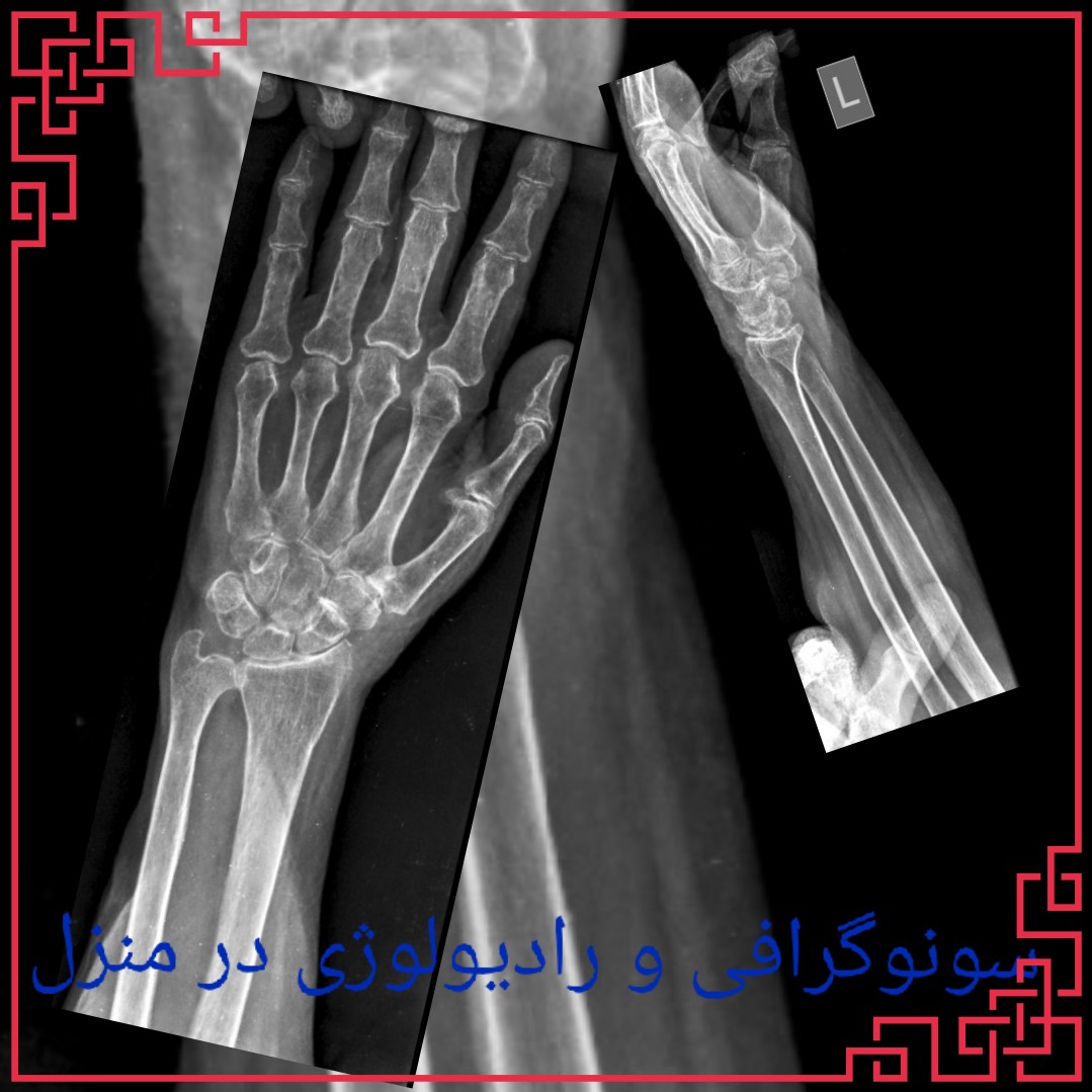 سونوگرافی در منزل و خانه رادیولوژی پرتابل در منزل تهران کرج،رادیولوژی در منزل تهران،گرافی پرتابل سیار در منزل تهران