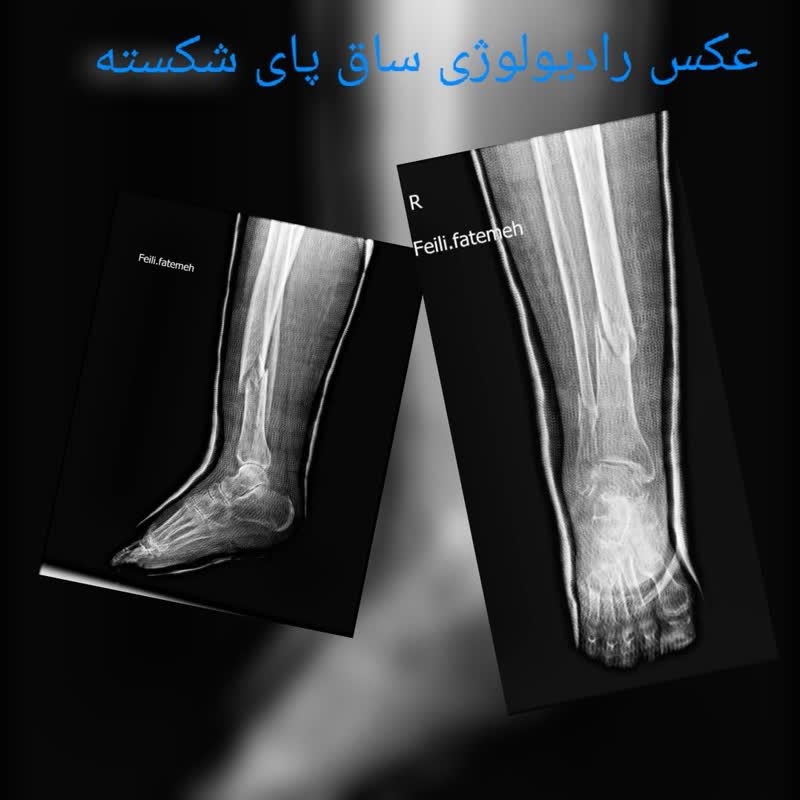 عکس رادیولوژی در منزل ساق و مچ پای شکسته در منزل تهران و کرج
