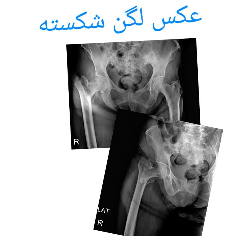 عکس رادیولوژی در منزل لگن ناسالم شکسته