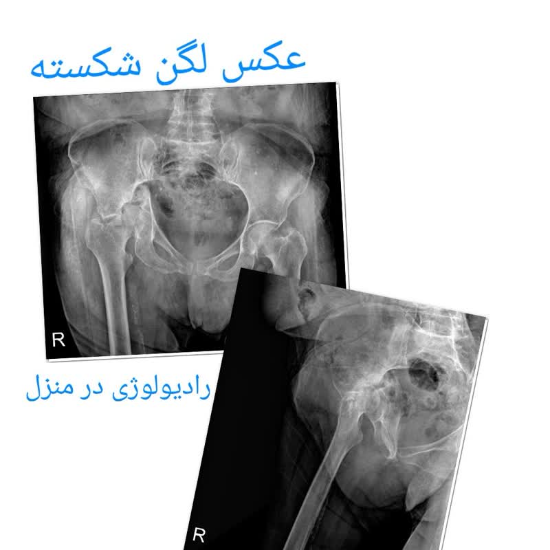 عکس رادیولوژی در منزل لگن و هیپ ران که مفصل لگن شکستگی داره