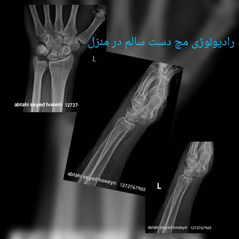 عکس رادیولوژی در منزل مچ دست سالم
