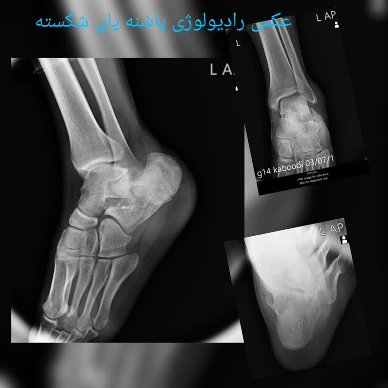 عکس رادیولوژی در منزل پاشنه پای شکسته