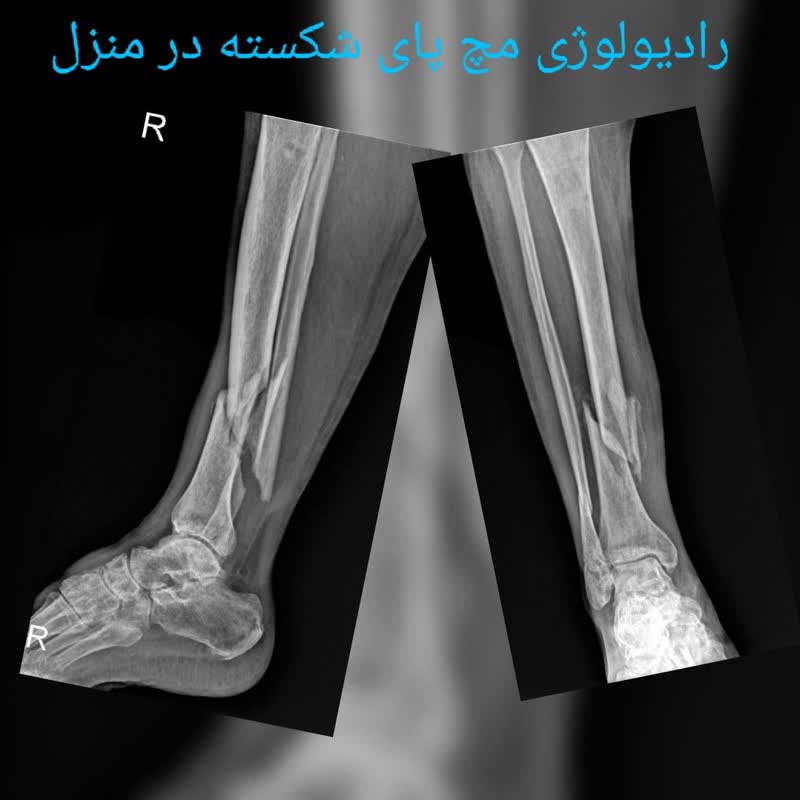 عکس رادیولوژی ساق پای شکسته در منزل