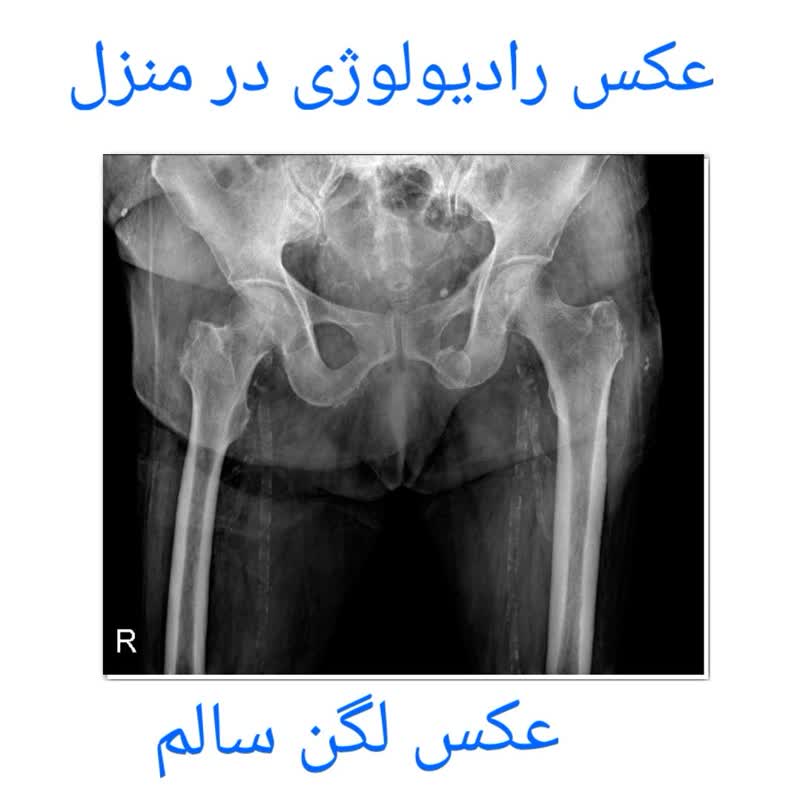 عکس رادیولوژی لگن سالم 