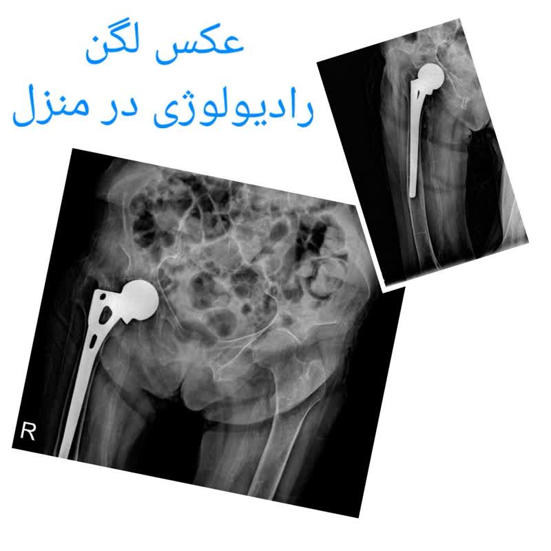 عکس رادیولوژی لگن ناسالم و شکسته بعد از عمل