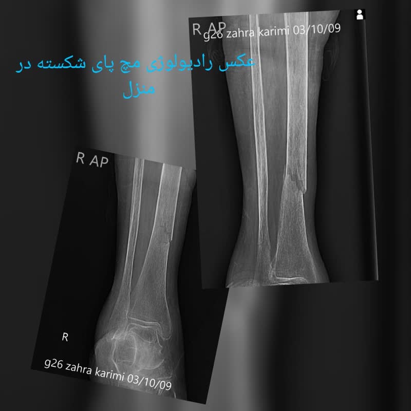 عکس رادیولوژی مچ پای شکسته در منزل تهران کرج