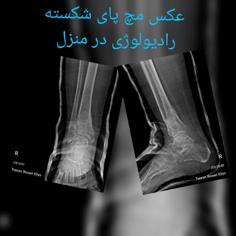 عکس رادیولوژی مچ پای شکسته در منزل