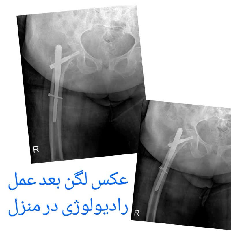 عکس لگن شکسته در منزل رادیولوژی در منزل الو رادیولوژی