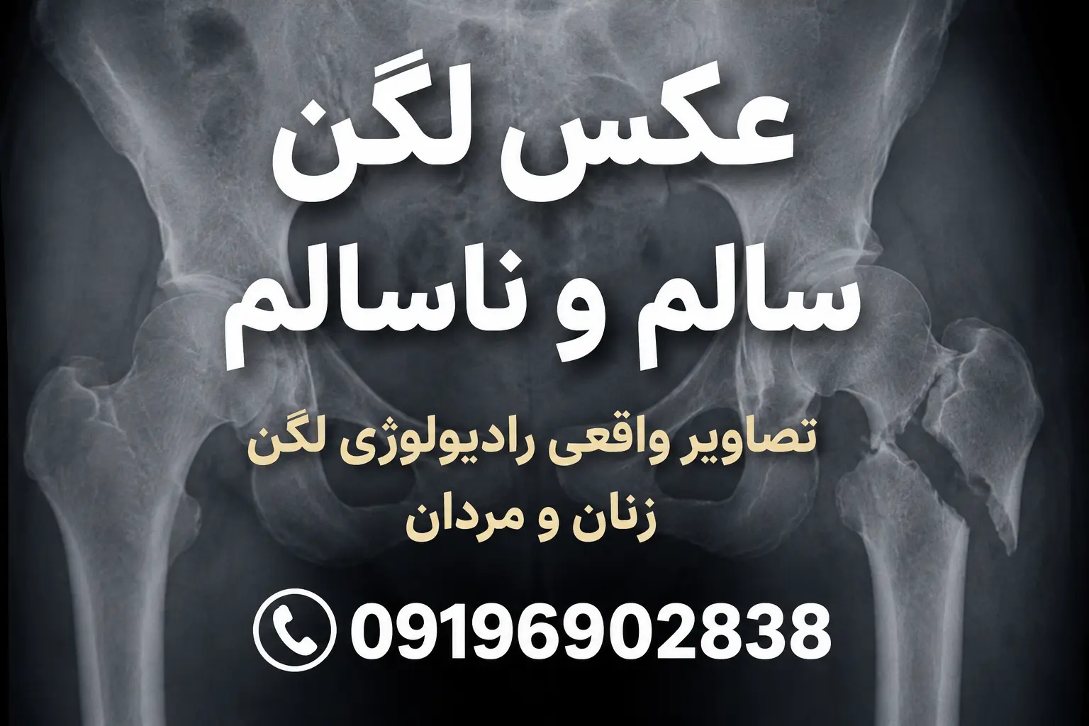 عکس لگن سالم و ناسالم | تصاویر واقعی رادیولوژی لگن زن و مرد