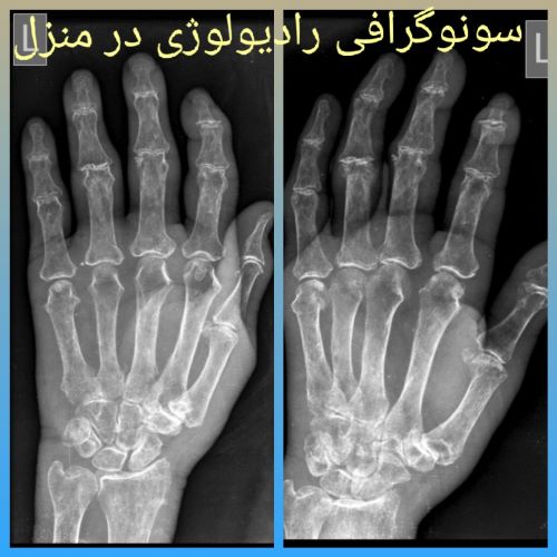 رادیولوژی انگشتان دست و پا در منزل