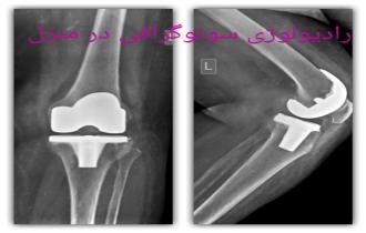 رادیولوژی زانو در منزل