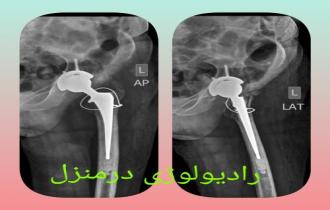 عکس رادیولوژی پرتابل و سیار در منزل 